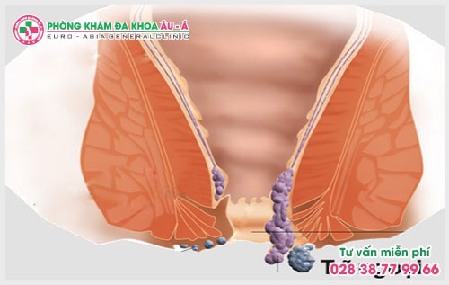 Bạn có biết dấu hiệu bệnh trĩ ngoại chưa?