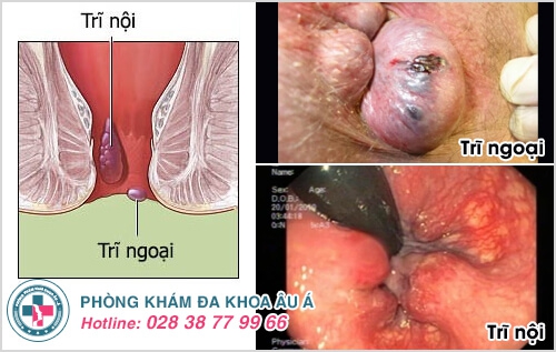 Nứt hậu môn, rách hậu môn có nguy hiểm không?