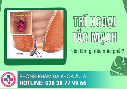 Triệu chứng của trĩ tắc mạch 