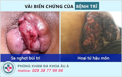 Bệnh trĩ ngoại độ 1, độ 2: cần chữa ngay để tránh biến chứng