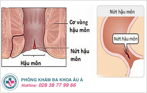 Nứt kẽ hậu môn