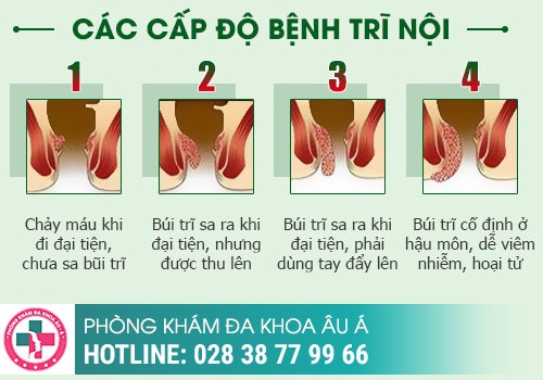 Vỡ Búi Trĩ Xung Huyết 