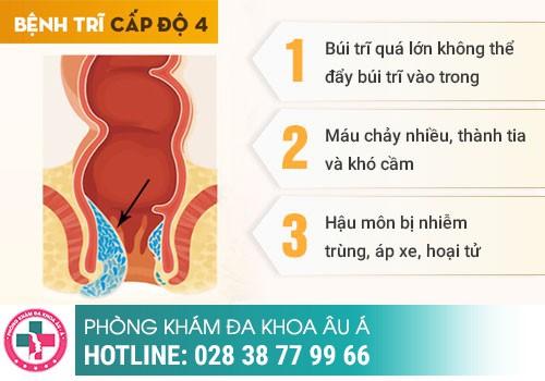 Triệu chứng bệnh trĩ độ 4