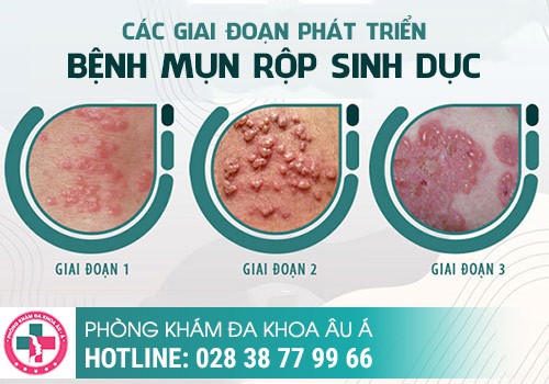 Mọc mụn hậu môn là bệnh gì?