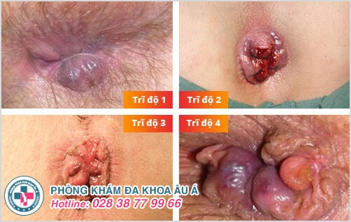Biểu hiện bệnh trĩ nội và cách điều trị hiện nay