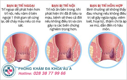 Bệnh trĩ, dấu hiệu bệnh trĩ và cách điều trị hiệu quả