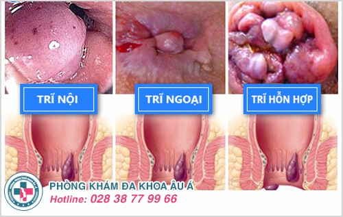 Phòng khám bệnh trĩ uy tín chất lượng tại TP.HCM