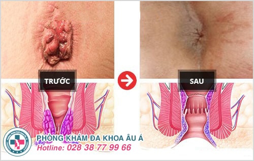 cách điều trị bệnh trĩ