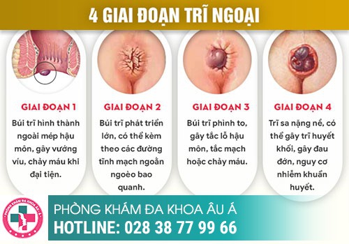 Vỡ Búi Trĩ Xung Huyết