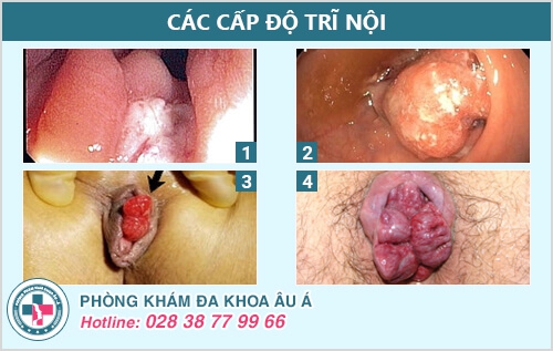 Bệnh trĩ nội và địa chỉ điều trị bệnh trĩ nội hiệu quả