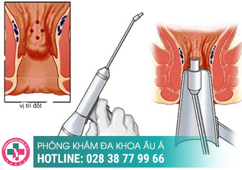 Cắt trĩ bằng tia laser