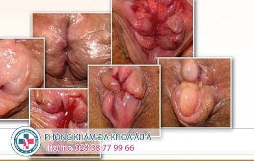 Cắt trĩ bao nhiêu tiền - Phòng Khám Đa Khoa Âu Á