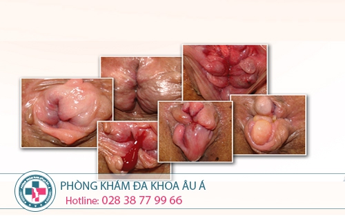 Cắt trĩ ở đâu tốt?