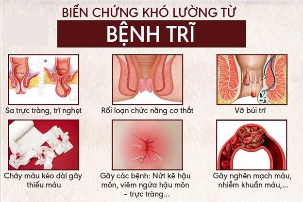bệnh trĩ