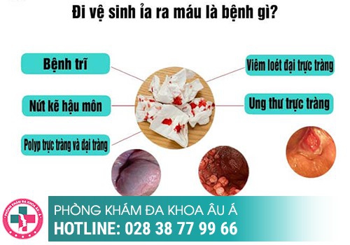 Chữa đi cầu ra máu bằng thuốc có được không?