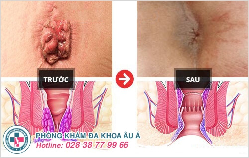 Chữa bệnh trĩ nội không còn là vấn đề khó