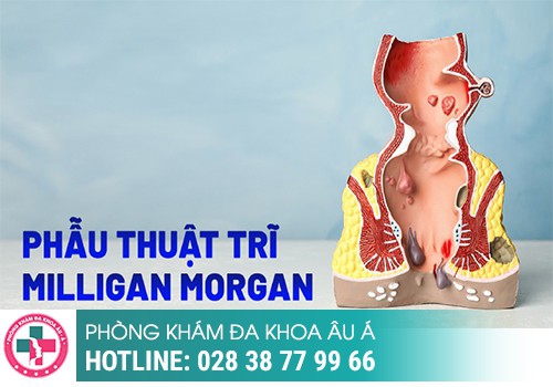 Cắt trĩ Milligan Morgan có thực sự hiệu quả?