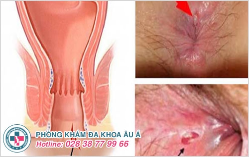 Các bệnh hậu môn trực tràng thường gặp và tác hại nguy hiểm