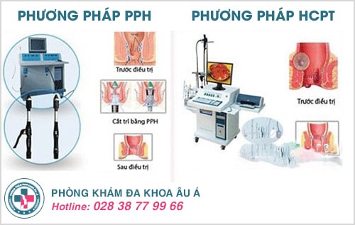[Thông tin thêm]: những điều cần biết trước khi cắt trĩ