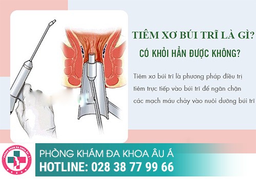 Điều trị trĩ bằng thuốc tiêm teo trĩ, tiêm xơ trĩ