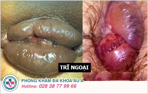 trĩ nội trĩ ngoại