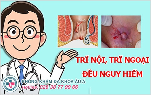 trĩ nội trĩ ngoại