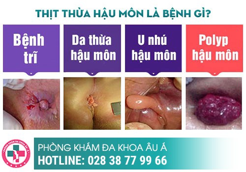 Chi phí khám và xử lý thịt thừa lòi ra ở hậu môn hiện nay bao nhiêu?