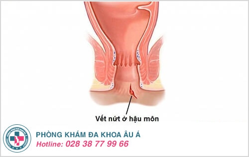 nứt hậu môn