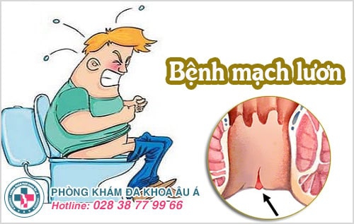 bệnh mạch lươn bệnh mạch lươn